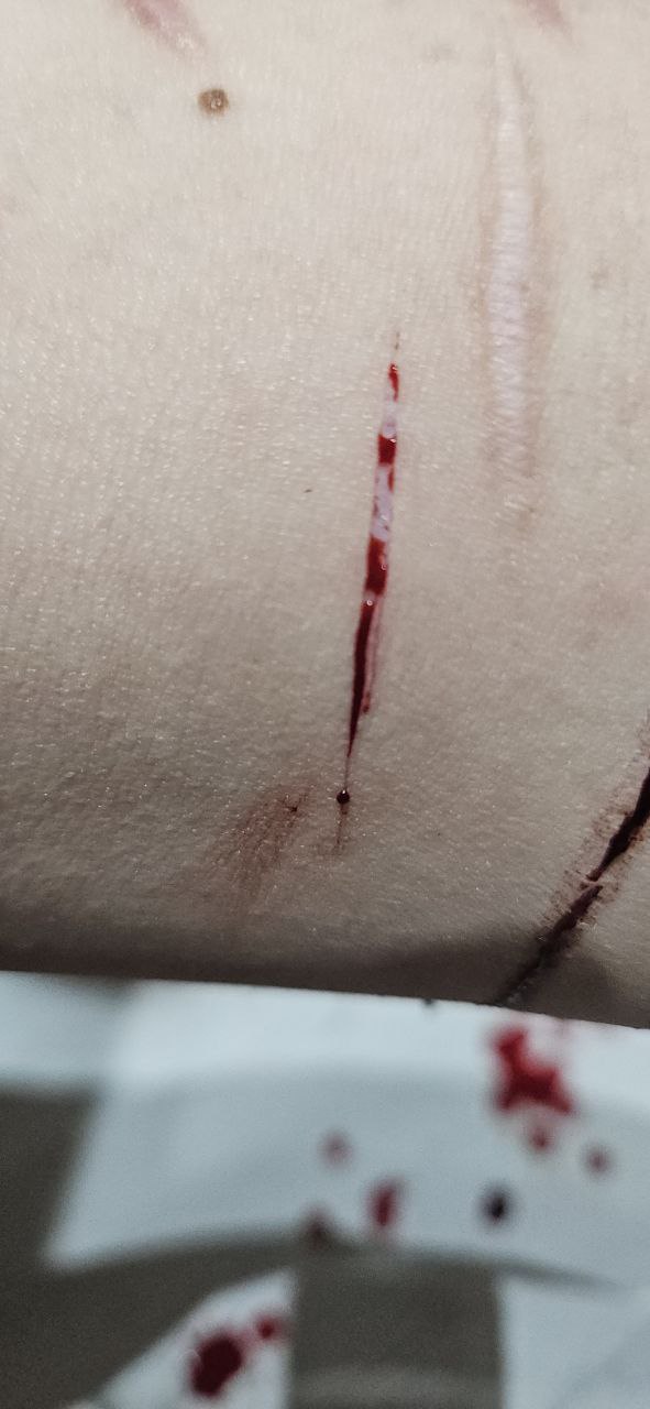 the white part is so pretty before it fills up with blood...>w< sorry for the shallow cuts everyone :c I just got out of the psychward recently and I haven't cut for over a month so I'm still getting myself back into it...